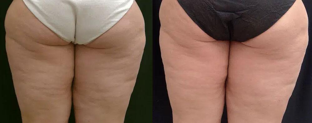 Cellulite Reduction Before & After Image