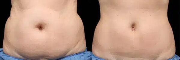 CoolSculpting Before & After Image