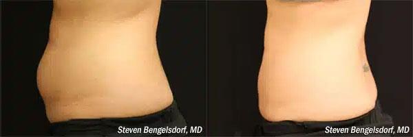 CoolSculpting Before & After Image