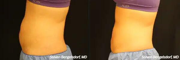 CoolSculpting Before & After Image