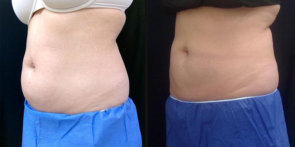 CoolSculpting Before & After Image