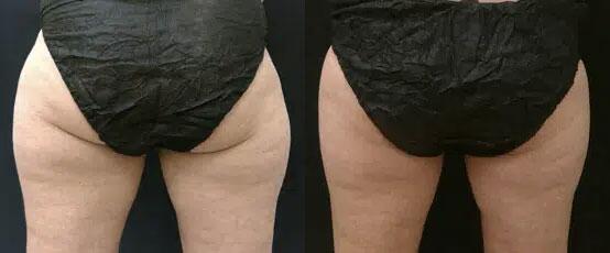 CoolSculpting Before & After Image