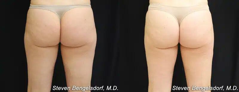 CoolSculpting Before & After Image