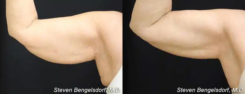CoolSculpting Before & After Image
