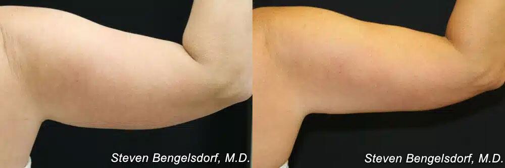 CoolSculpting Before & After Image