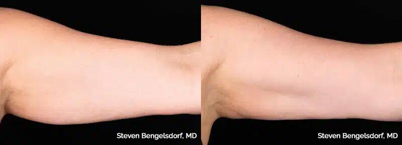 CoolSculpting Before & After Image