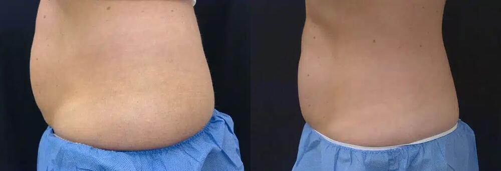 CoolSculpting Before & After Image