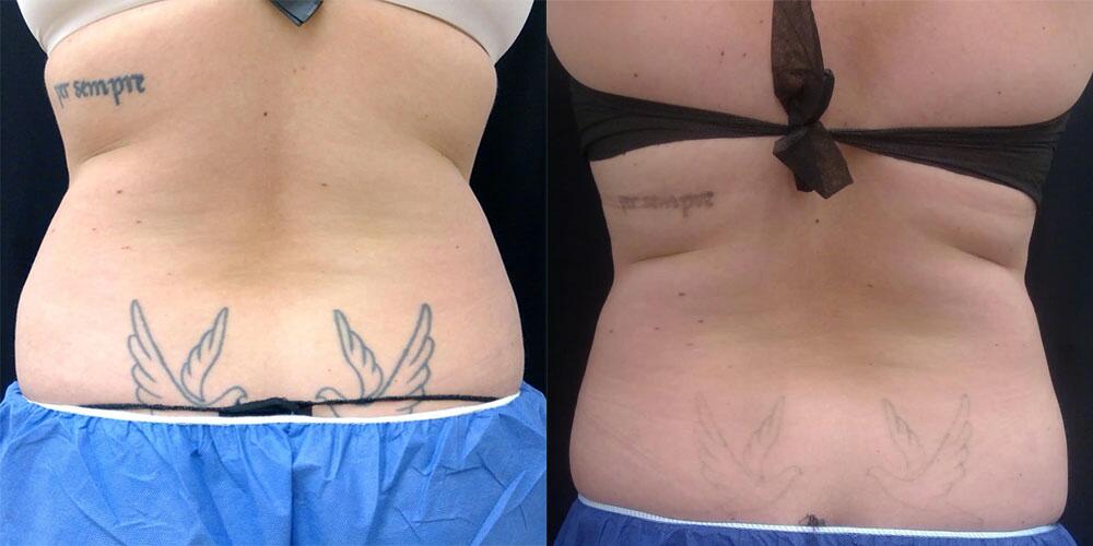 CoolSculpting Before & After Image