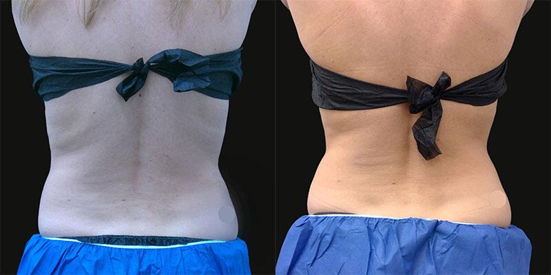 CoolSculpting Before & After Image