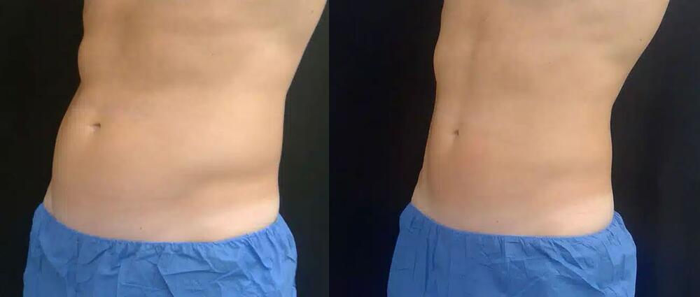 CoolTone Before & After Image