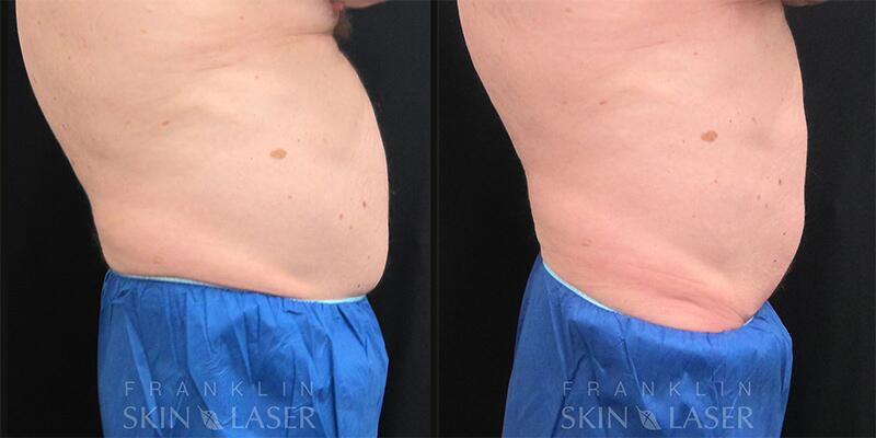 Emsculpt NEO Before & After Image