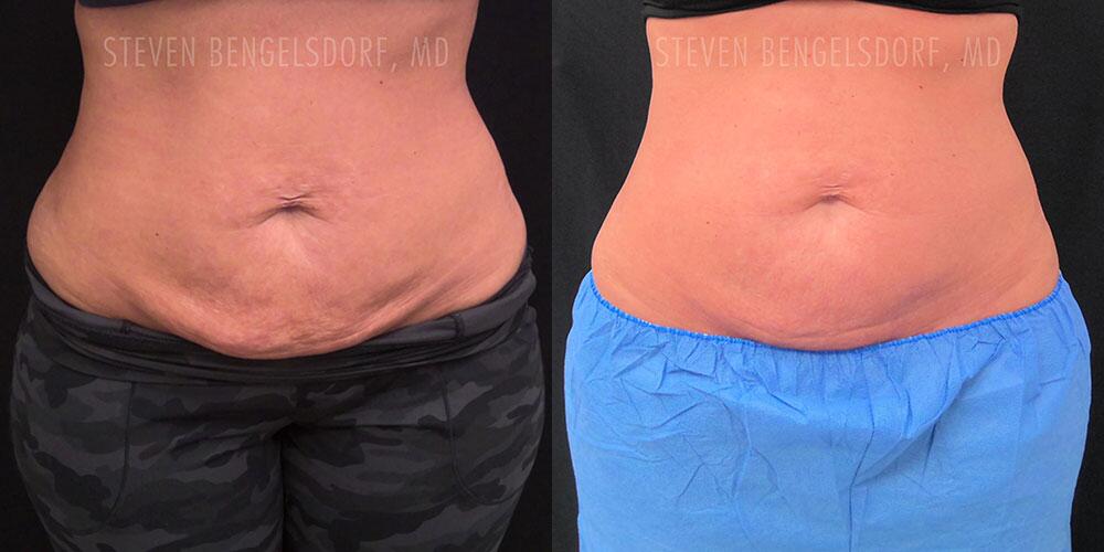 Morpheus8 Body Before & After Image