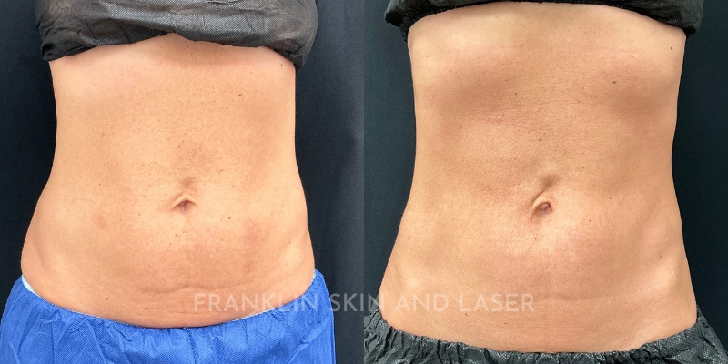 Morpheus8 Body Before & After Image