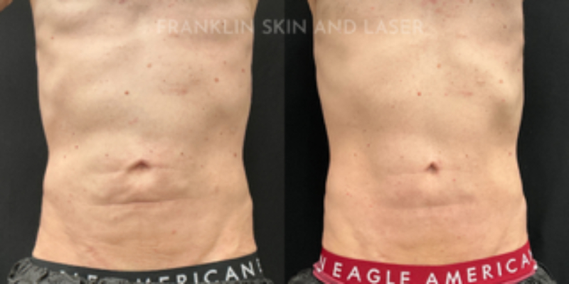 Morpheus8 Body Before & After Image