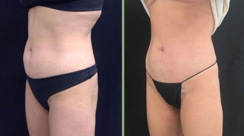 Weight Management Before & After Image