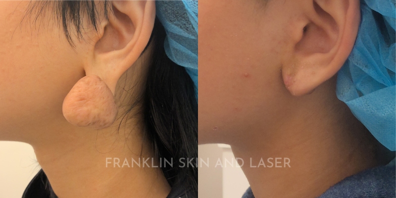 Keloid Removal Before & After Image
