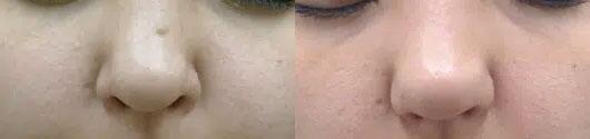 mole removal Before & After Image