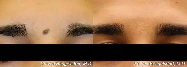 mole removal Before & After Image