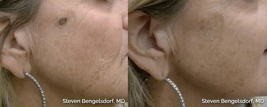 mole removal Before & After Image