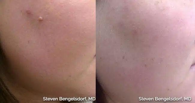 mole removal Before & After Image