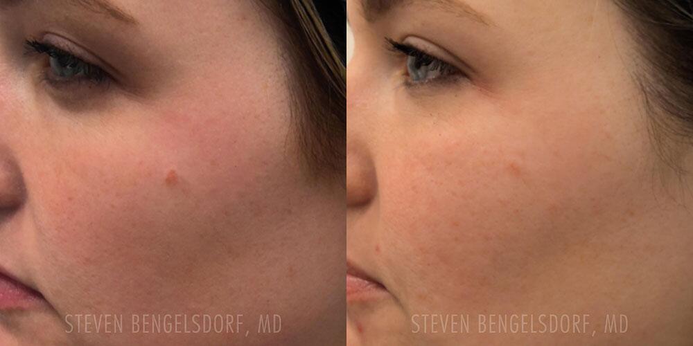 mole removal Before & After Image