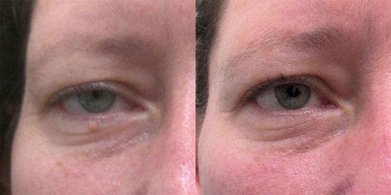 mole removal Before & After Image