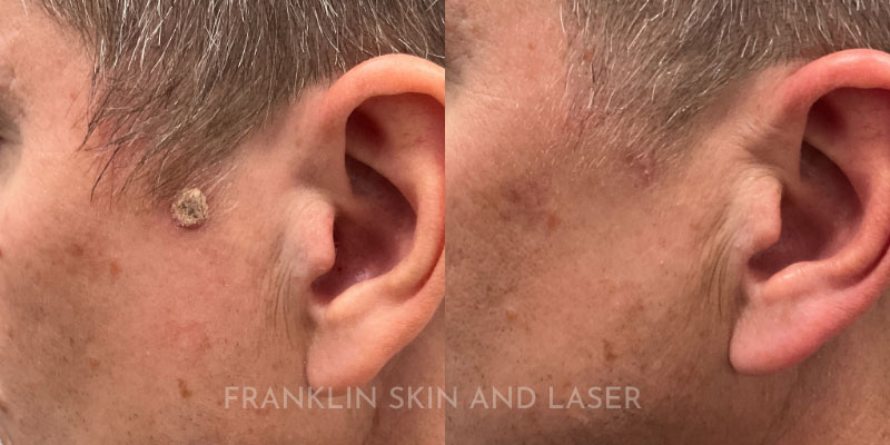 mole removal Before & After Image