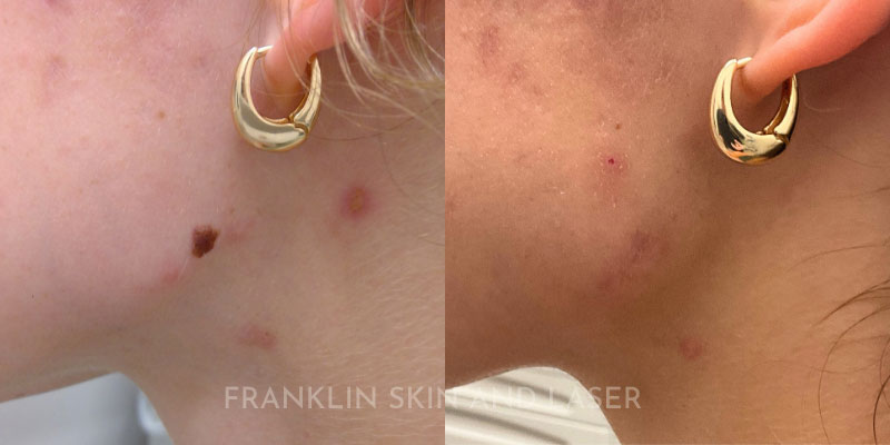Mole Removal Before & After Image