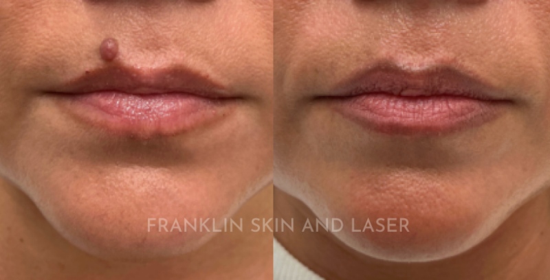 Mole Removal Before & After Image