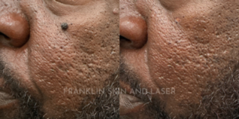 Mole Removal Before & After Image
