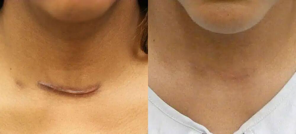 Scar Revision Before & After Image