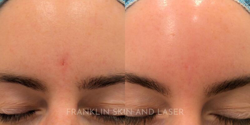 Scar Revision Before & After Image