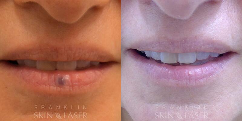 venous lake Before & After Image