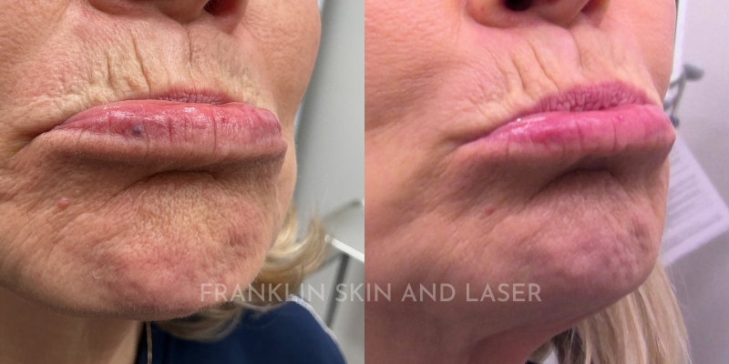 Venous Lake Removal Before & After Image