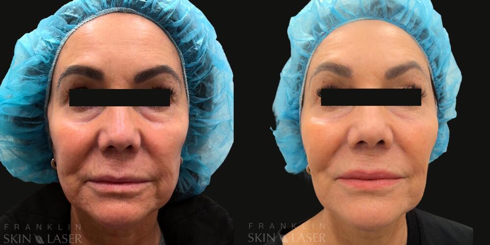 Clear Brilliant Before & After Image