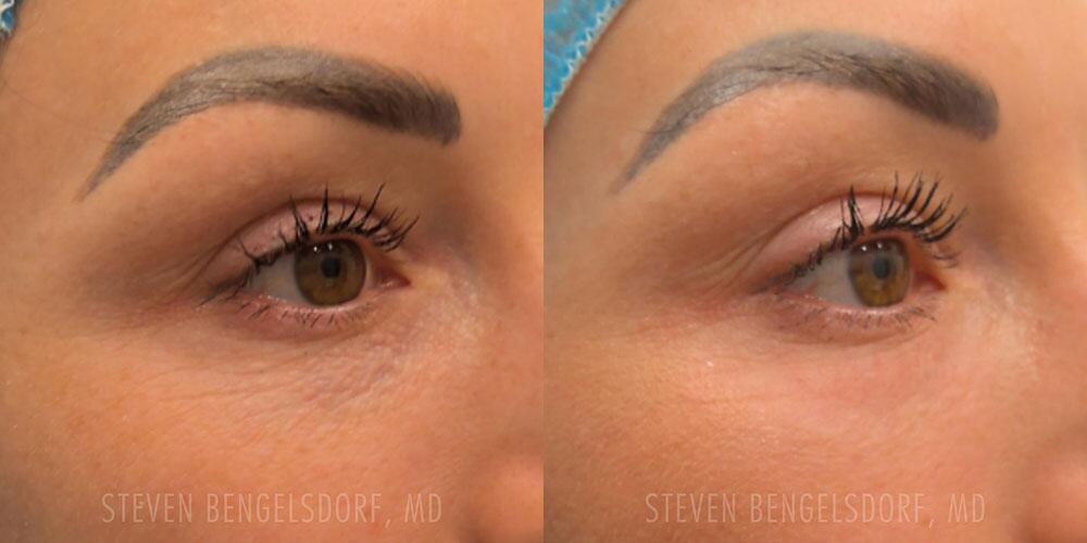 CO2 Laser Resurfacing Before & After Image