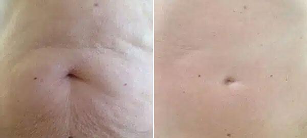 Microneedling Before & After Image