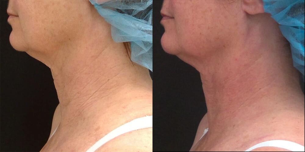 morpheus8 Before & After Image