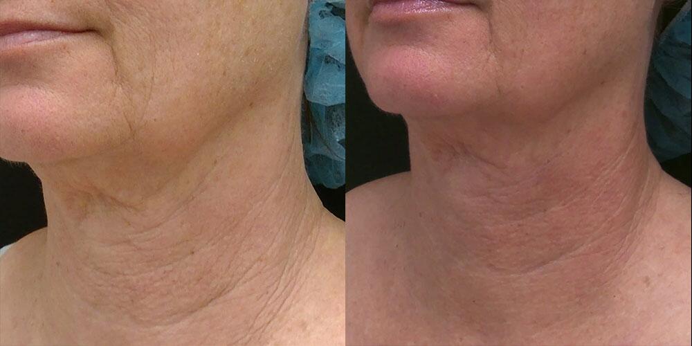 morpheus8 Before & After Image