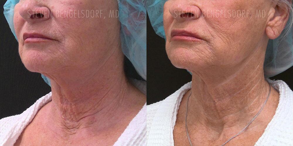 morpheus8 Before & After Image