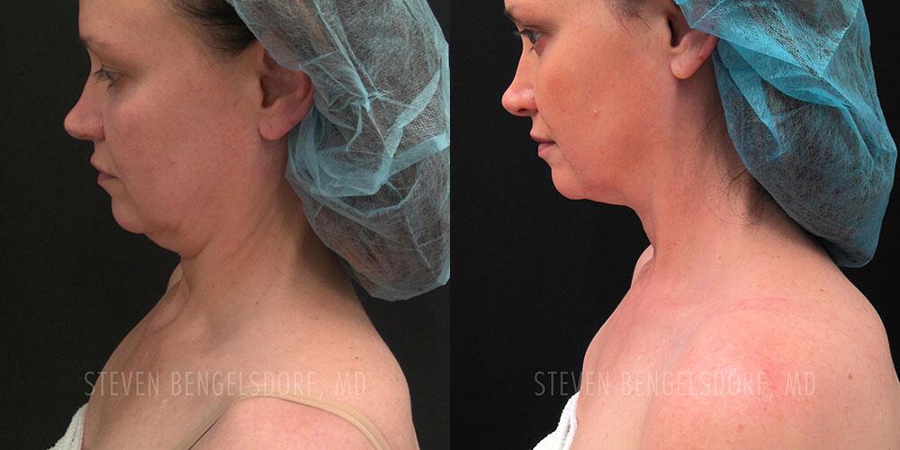 morpheus8 Before & After Image