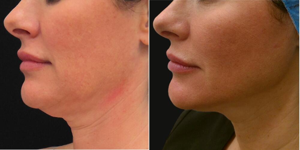 morpheus8 Before & After Image