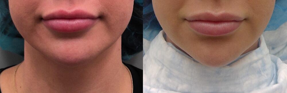 Morpheus8 Face Before & After Image