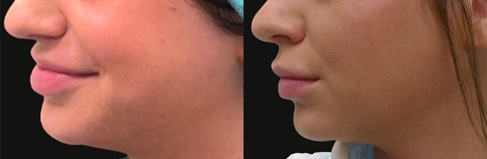 Morpheus8 Face Before & After Image