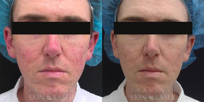 Morpheus8 Face Before & After Image