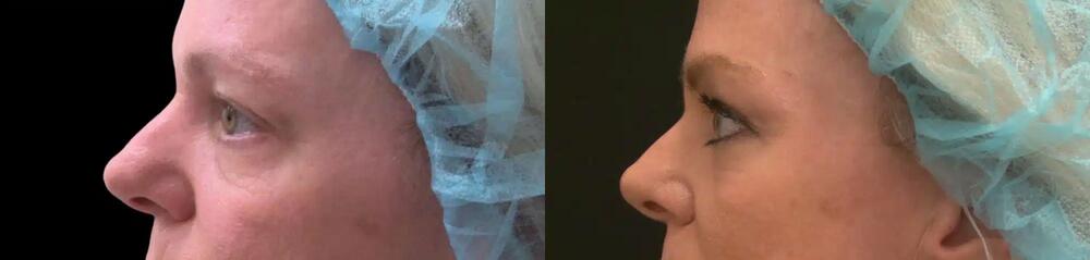 Plasma Pen Before & After Image