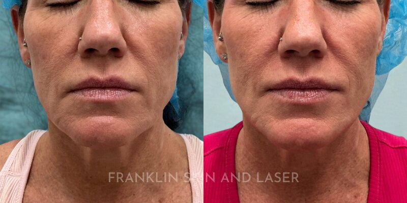 Thread Lift Before & After Image