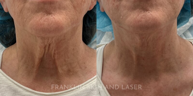 Thread Lift Before & After Image