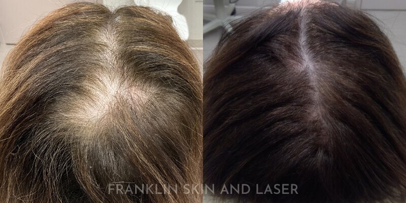 Hair Restoration Before & After Image