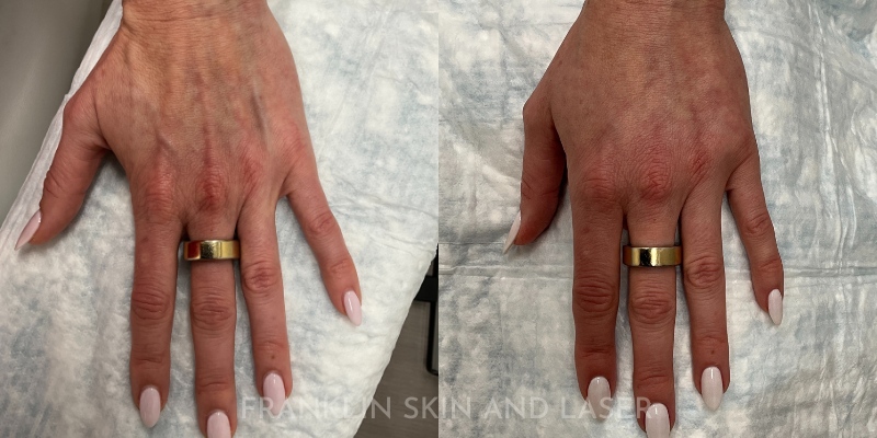 Hand Filler Before & After Image